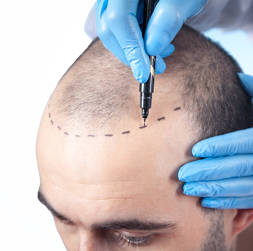 Patient,Suffering,From,Hair,Loss,In,Consultation,With,A,Doctor.